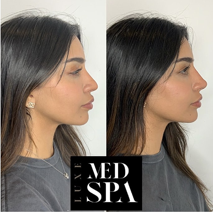 Before and after profile view of face.